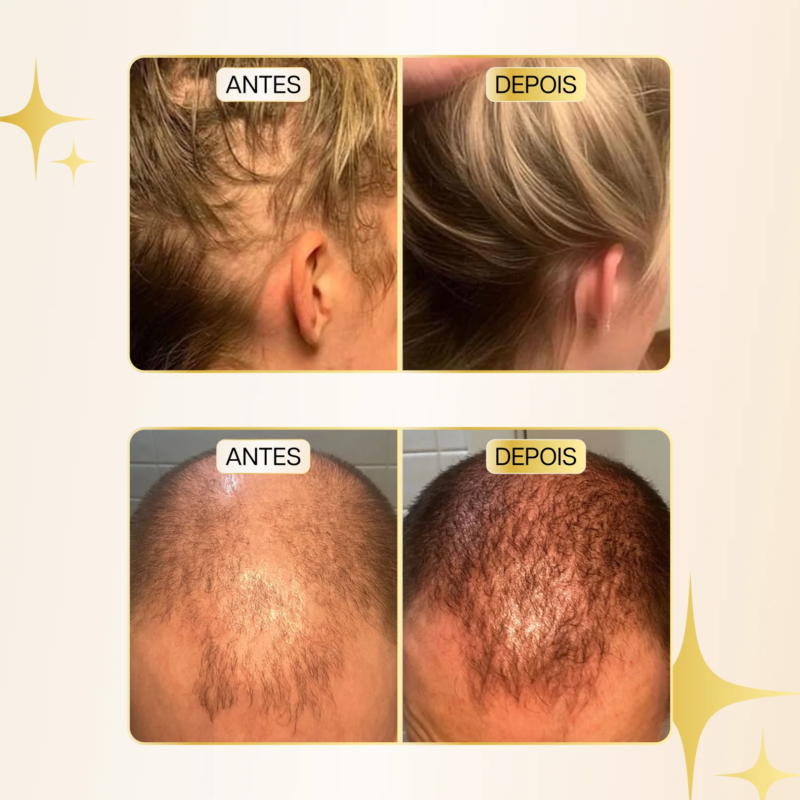 Escova de Terapia Capilar 4 em 1 - RevitaHair Pro™